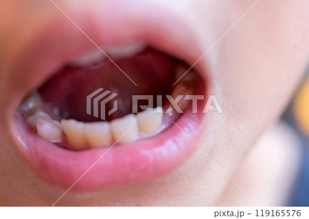 下あごの乳犬歯が生え始めた10歳児 119165576