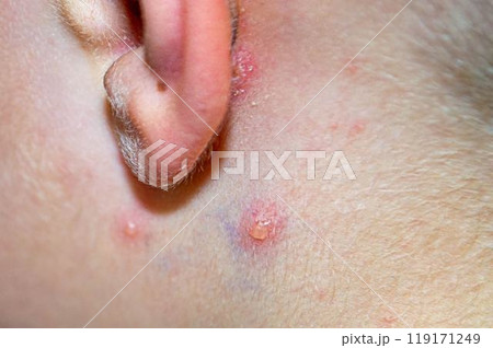 Varicella virus or Chickenpox bubble rash on child 119171249