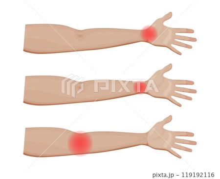 Shoulder and Elbow Joint Pain Vector Illustration 119192116