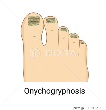 Toenail onychogryphosis, nail pathology, Ram Horn Nails 119192118