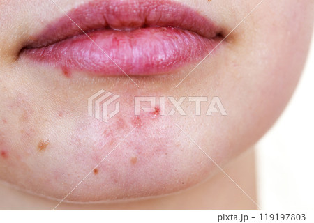 Female face with acne skin problem Female face with acne skin problem 119197803