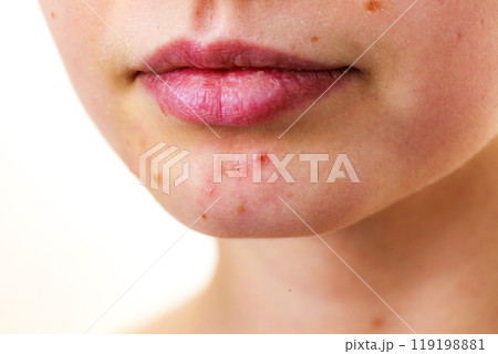 Female face with acne skin problem Female face with acne skin problem 119198881