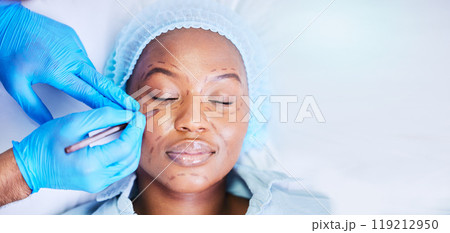 Plastic surgery, pen and black woman sleep on a hospital bed with dermatology with mockup space. Surgeon, facial change and medical filler for skincare, cosmetics and wellness in a clinic with doctor 119212950