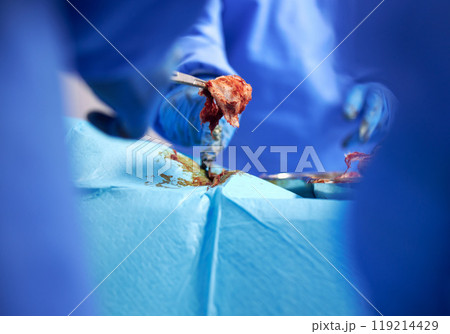 Hands, surgery and cancer with doctors in a hospital to remove a tumor closeup during a medical procedure. Healthcare, medicine and operation with a surgeon team in a clinic for emergency transplant 119214429