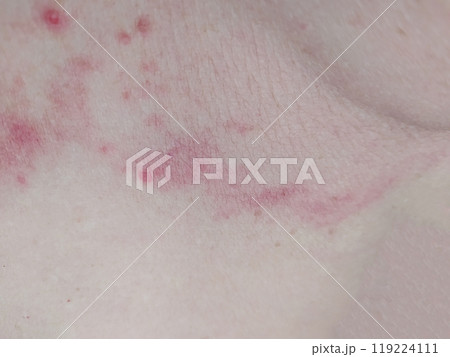 Fungus mycosis, fungal rash on woman's skin Fungus mycosis, fungal rash on woman's skin 119224111