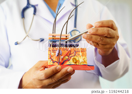 Hair transplant, Asian dermatologist doctor holding skin structure anatomy model for treatment in hospital. Hair transplant, Asian dermatologist doctor holding skin structure anatomy model for treatment in hospital. 119244218
