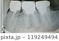 歯のレントゲン写真(下の臼歯・詰め物あり)_1441 119249494