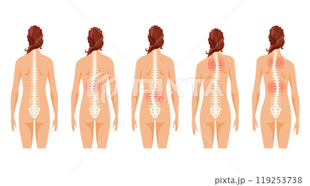 This article covers the different types of scoliosis affecting individuals of all ages This article covers the different types of scoliosis affecting individuals of all ages 119253738