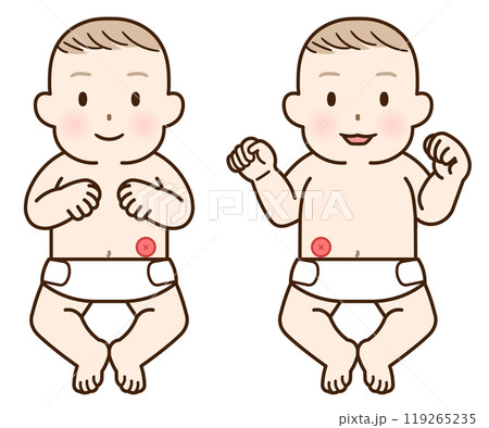 人工肛門、ストーマ、大腸、子供、こども、赤ちゃん、イラスト、illustration 119265235