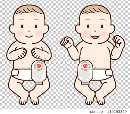 Artificial anus, stoma, colon, child, baby, illustration 119265239