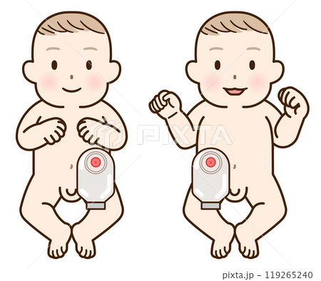 人工肛門、ストーマ、大腸、子供、こども、赤ちゃん、イラスト、illustration 119265240