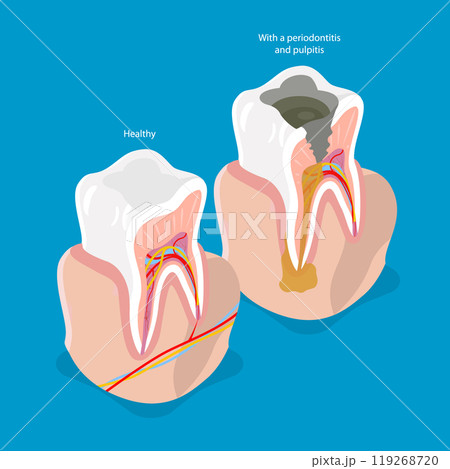 3D Isometric Flat Vector Illustration of Tooth Issues, Dentistry and Dental Care 119268720
