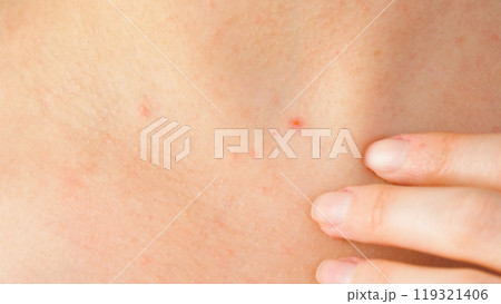 woman concerns irritated skin on the neck. skin with allergic reactions, acne. Care and treatment of problem skin. skin health. woman concerns irritated skin on the neck. skin with allergic reactions, acne. Care and treatment of problem skin. skin health. 119321406