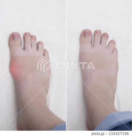 Hallux valgus, deformation of the big toe. Orthopedic doctor examines the bone on the foot, diagnoses foot pathology Hallux valgus, deformation of the big toe. Orthopedic doctor examines the bone on the foot, diagnoses foot pathology 119327198
