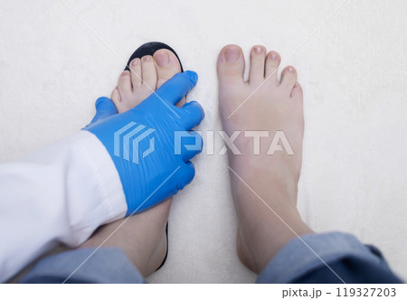Presentation of incorrect footwear that deforms the foot. Small size of the insole, which causes pain in the foot and valgus. After an example of an anatomical insole 119327203