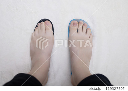 Presentation of incorrect footwear that deforms the foot. Small size of the insole, which causes pain in the foot and valgus. After an example of an anatomical insole 119327205