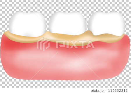Teeth and gums with tartar Bacteria or plaque adheres 119332812