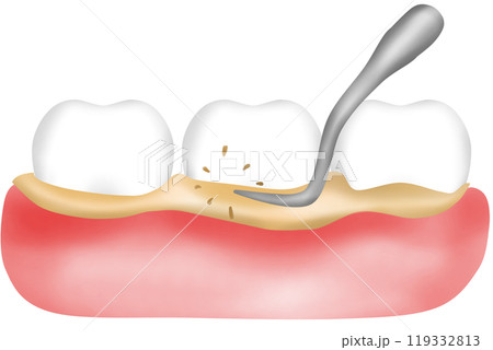 Scaling the gums and teeth Scaling the gums and teeth 119332813