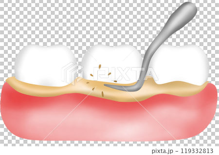 Scaling the gums and teeth Scaling the gums and teeth 119332813
