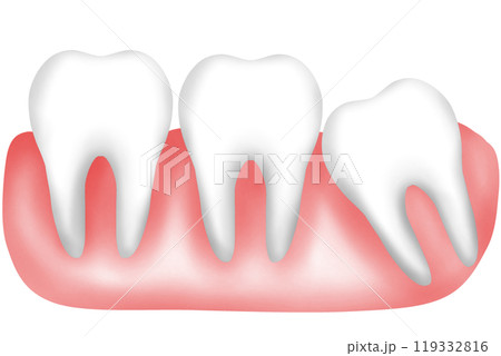 Impacted tooth, Tilted tooth or Crowded teeth Impacted tooth, Tilted tooth or Crowded teeth 119332816