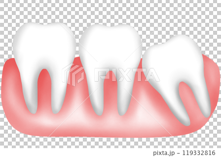Impacted tooth, Tilted tooth or Crowded teeth Impacted tooth, Tilted tooth or Crowded teeth 119332816