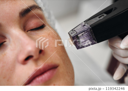 Woman receiving facial treatment with a microneedling device in clinic 119342246