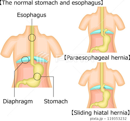 食道 胃 ヘルニア イラスト 英語 食道 胃 ヘルニア イラスト 英語 119353232