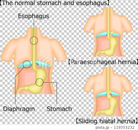 食道 胃 ヘルニア イラスト 英語 食道 胃 ヘルニア イラスト 英語 119353232