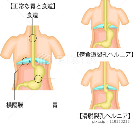 食道　胃　ヘルニア　イラスト　日本語 119353233