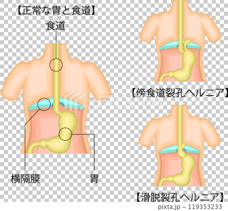 食道　胃　ヘルニア　イラスト　日本語 119353233