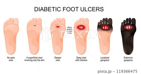 Diabetic foot ulcers. Classification Diabetic foot ulcers. Classification 119366475