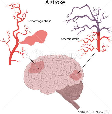 . Hemorrhagic stroke and ischemic stroke of the brain. . Hemorrhagic stroke and ischemic stroke of the brain. 119367806