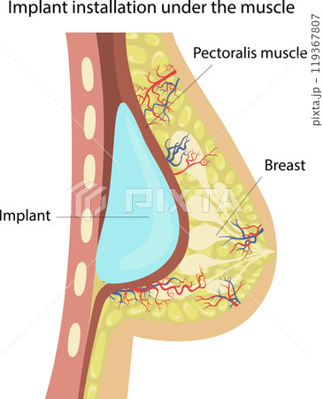 Breast augmentation with implants. Breast augmentation with implants. 119367807