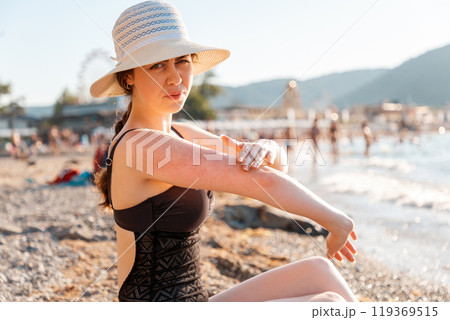 A woman in a swimsuit sits on the beach and irritably scratches her hand with redness and a rash. Outdoor. Concept of insect bites and allergies 119369515