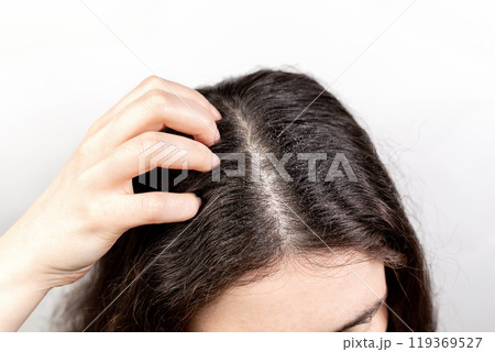 The woman scratches her head with her hand, showing a parting of dark hair with dandruff. Close up. The view from the top. White background. The concept of dandruff and pediculosis 119369527
