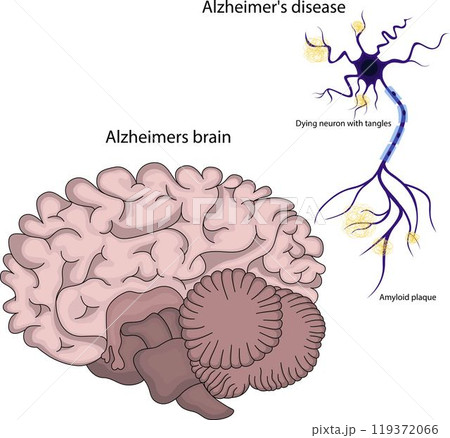 brain with Alzheimers disease. 119372066
