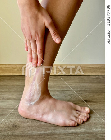 Concept treatment by applying cream by hand to after surgery scar on the ankle Concept treatment by applying cream by hand to after surgery scar on the ankle 119377796