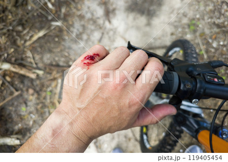 Mountain bike accident. Rider hand wound with red blood from hitting a tree stump 119405454