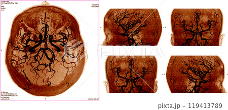 Cerebrovascular in the brain Cerebrovascular in the brain 119413789