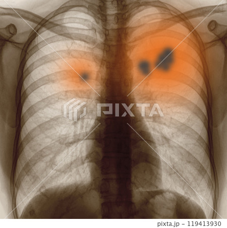 lung cancer or emphysema. lung cancer or emphysema. 119413930