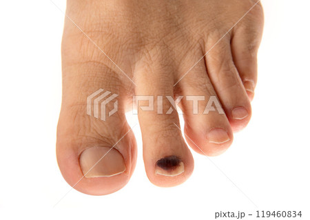 男性の足指爪の内出血 119460834