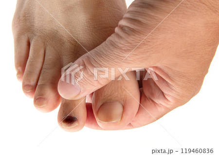 男性の足指爪の内出血 119460836