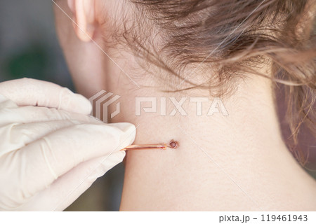 Woman examing her abnormal mole. Dermatology procedure. Doctor checking Woman examing her abnormal mole. Dermatology procedure. Doctor checking 119461943