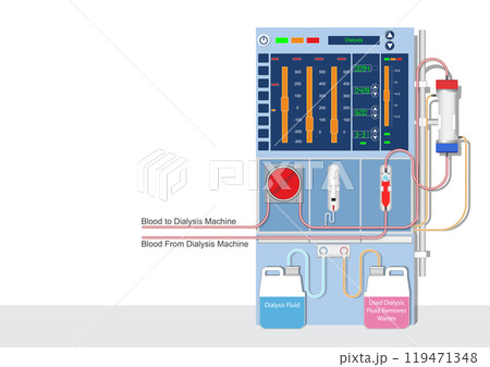 Hemodialysis is a machine filters wastes. 119471348