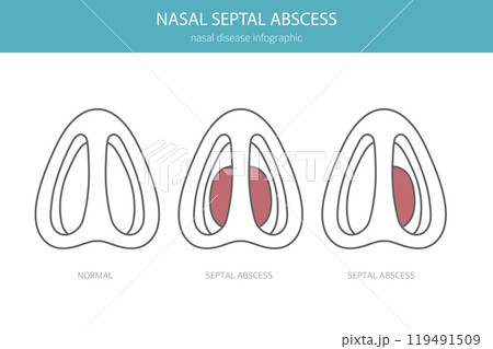 Nasal septal abscess. Nasal diseases. Medical infographic design Nasal septal abscess. Nasal diseases. Medical infographic design 119491509