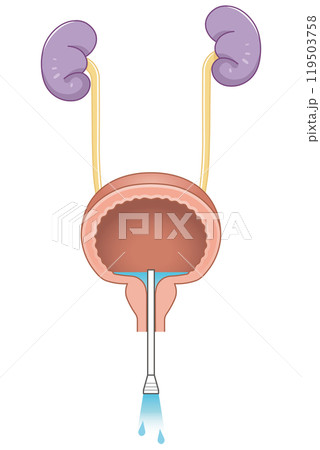 自己導尿のイラスト 119503758