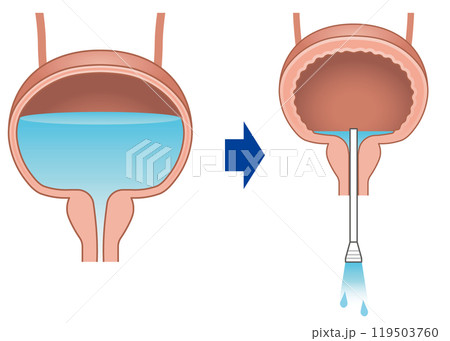 自己導尿のイラスト 119503760