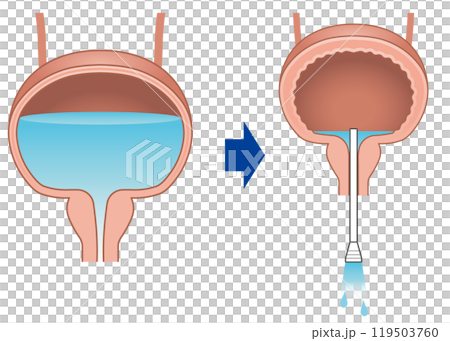 自己導尿のイラスト 119503760