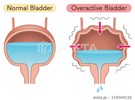 過活動膀胱、Overactive bladderのイラスト 過活動膀胱、Overactive bladderのイラスト 119504238