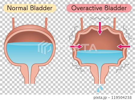 過活動膀胱、Overactive bladderのイラスト 過活動膀胱、Overactive bladderのイラスト 119504238
